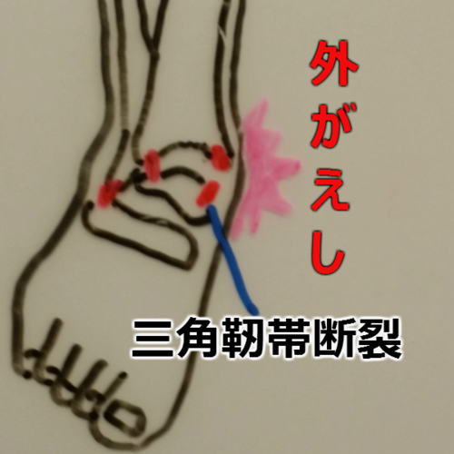 外反捻挫