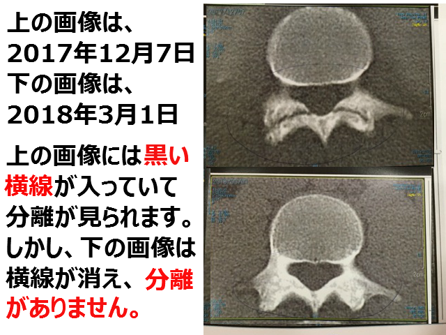 腰椎分離症CT